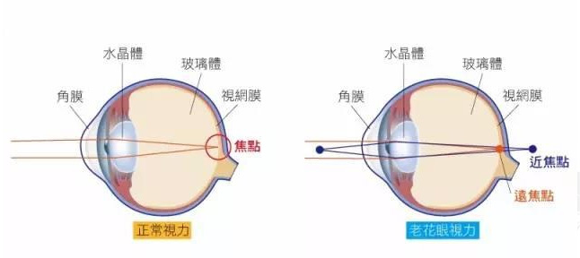 白內(nèi)障和老花眼區(qū)別，老花眼發(fā)病率正呈現(xiàn)年輕化趨勢(shì)