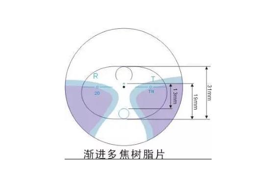 美麗島多焦鏡適合的人群，需要注意的事項(xiàng)